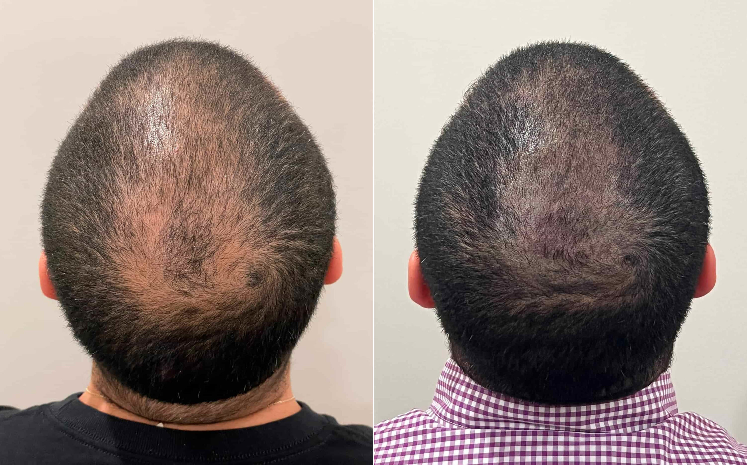 scalp micro pigmentation for thinning hair