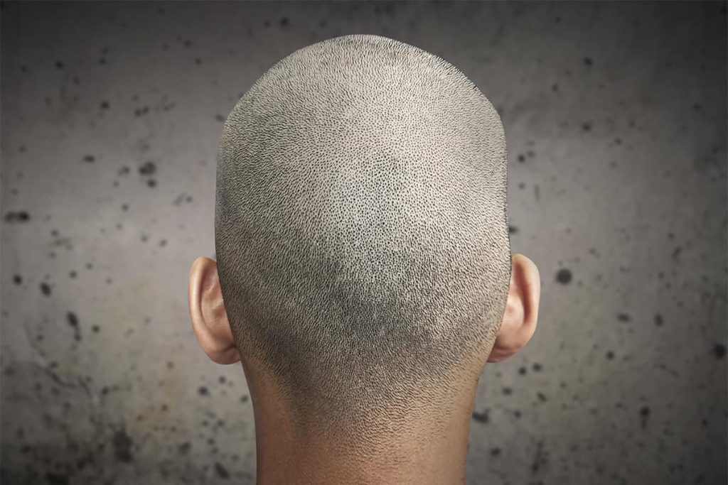 Benefits of scalp micro pigmentation